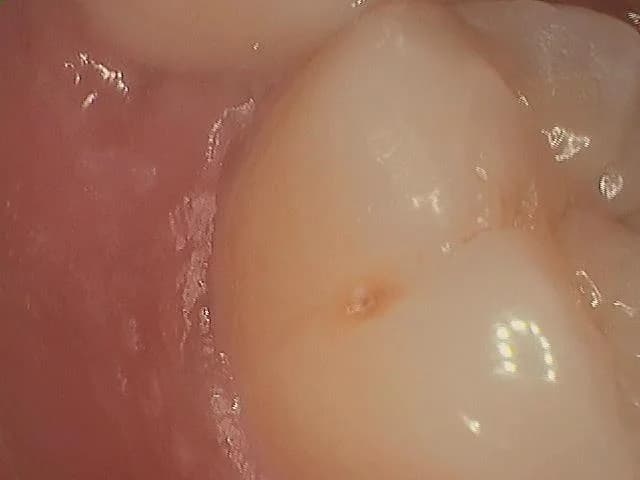 Black Spot on Tooth: What Could It Be and Why It Happens?