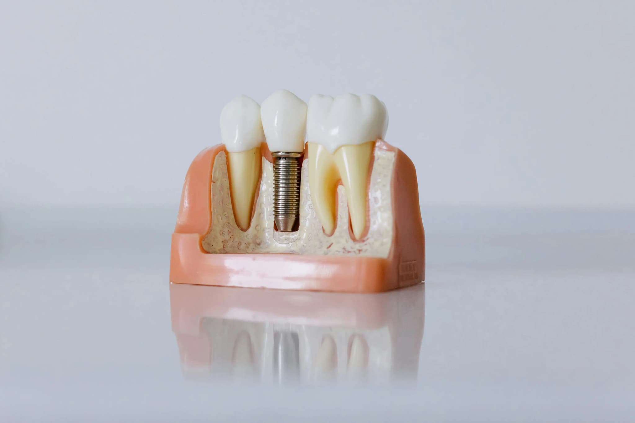 Dental Implants: The Modern Solution for Missing Teeth