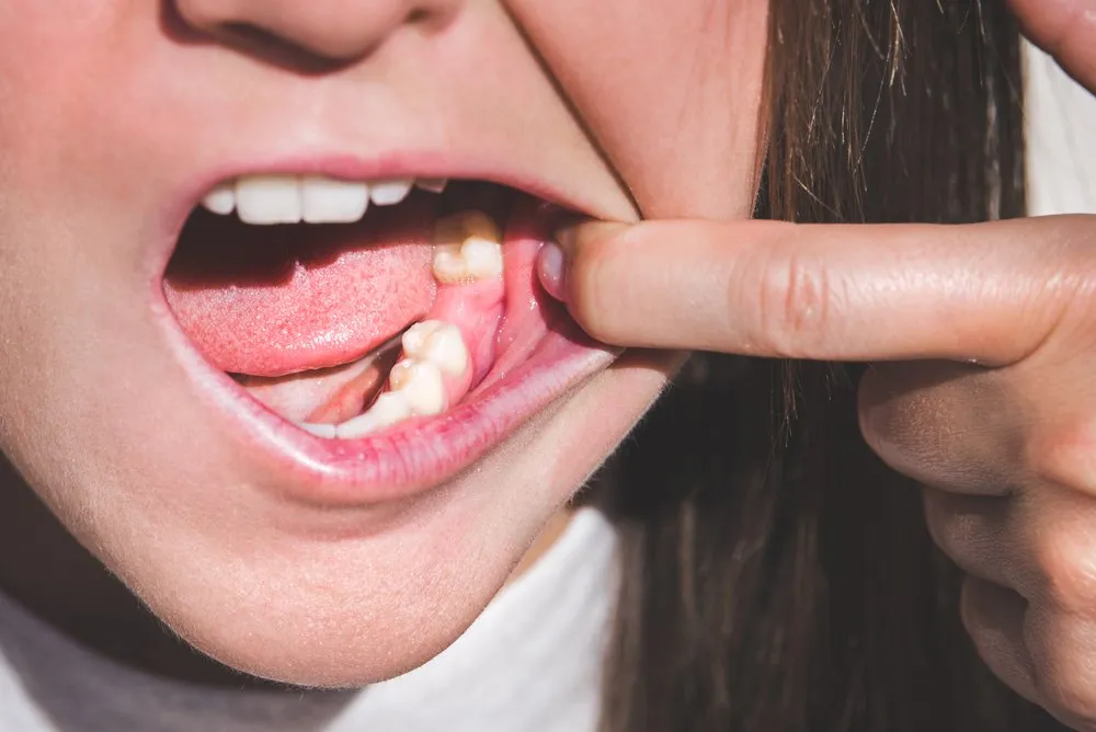Normal Socket After Tooth Extraction: Healing Stages and Care Guide