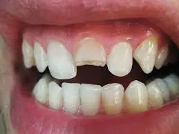 Broken Tooth Emergency Care