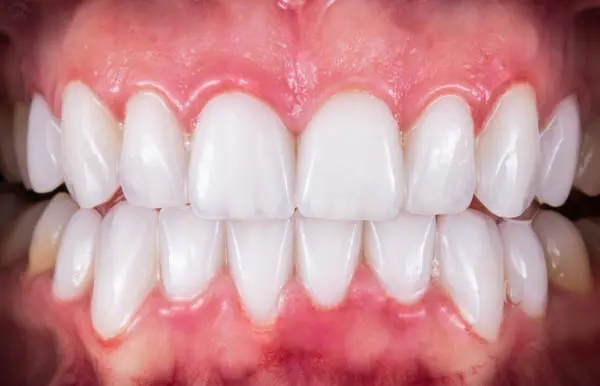 Cosmetic Tooth Reshaping
