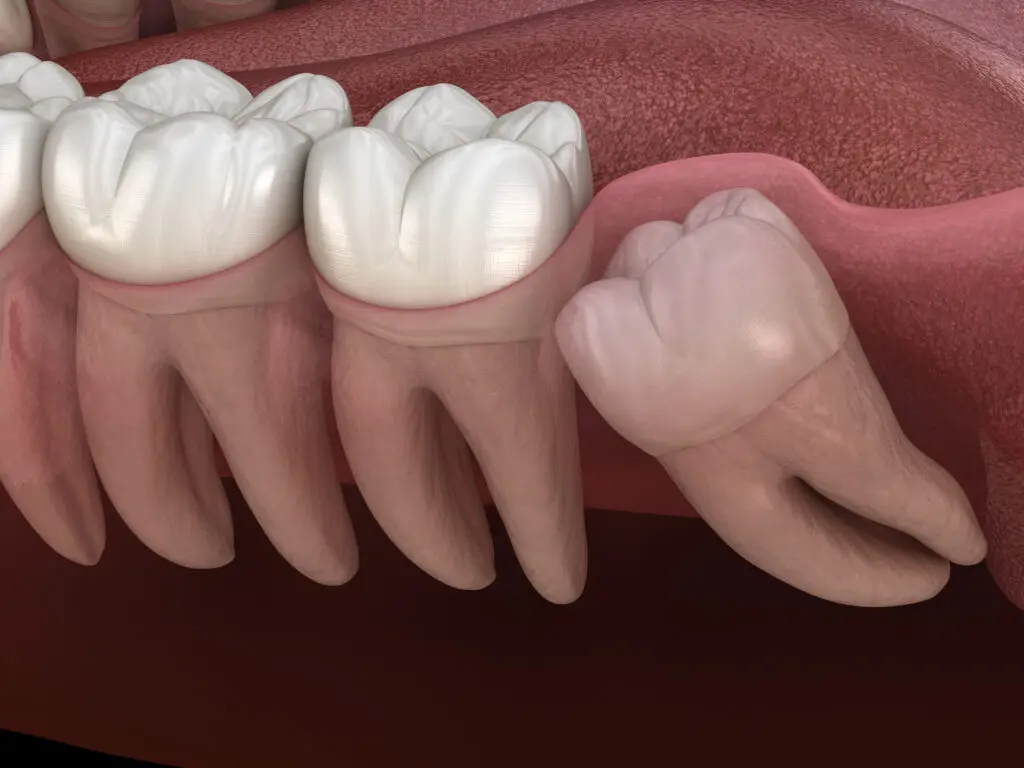 Emergency Wisdom Tooth Pain Treatment