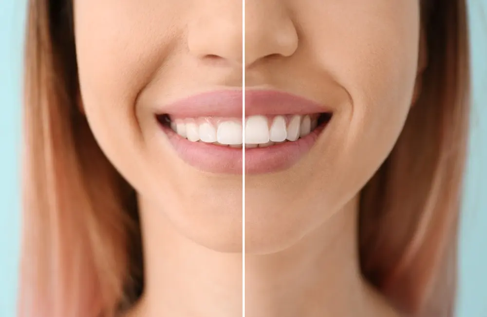 Gum Contouring