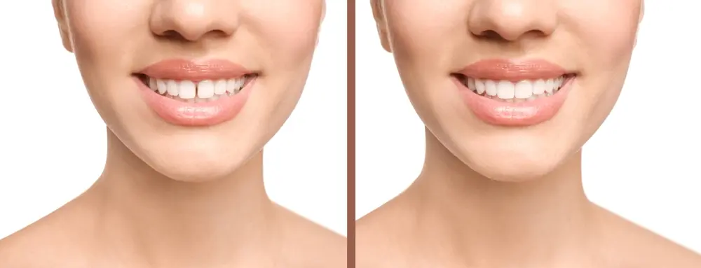 Tooth Gap Repair
