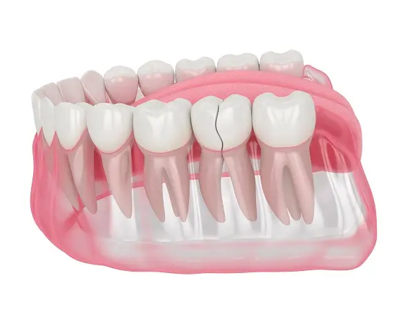 Tooth Repair for Chipped Teeth