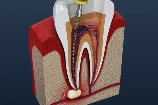 Root Canal Treatments