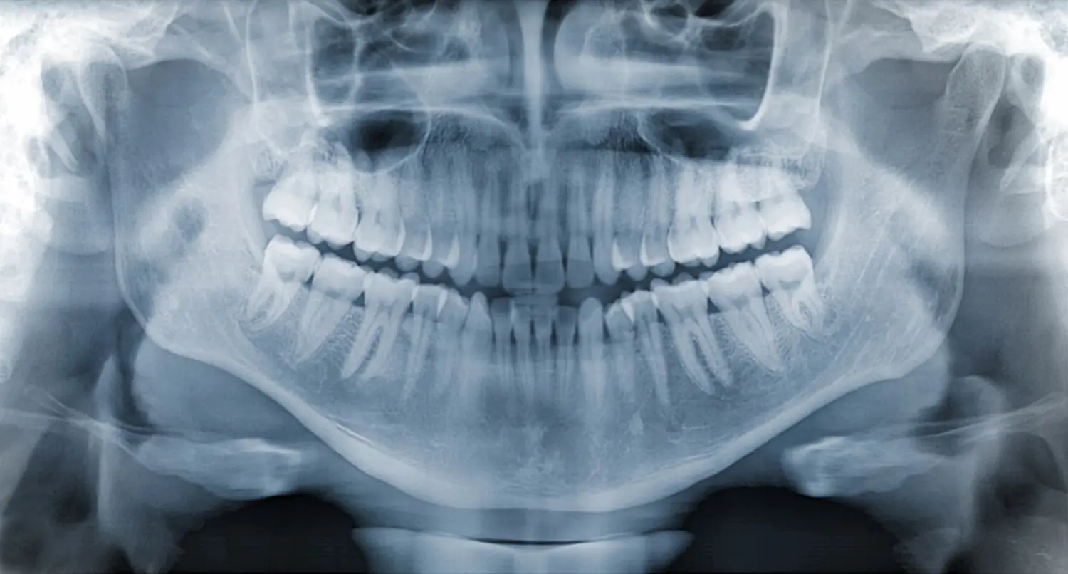 Dental X-Rays at Spire Dental Care in Langley, BC