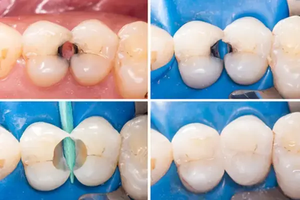 Cracked Tooth Restoration at Spire Dental Care in Langley, BC