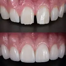 Dental Bonding at Spire Dental Care in Langley, BC
