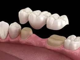 Dental Bridges at Spire Dental Care in Langley, BC
