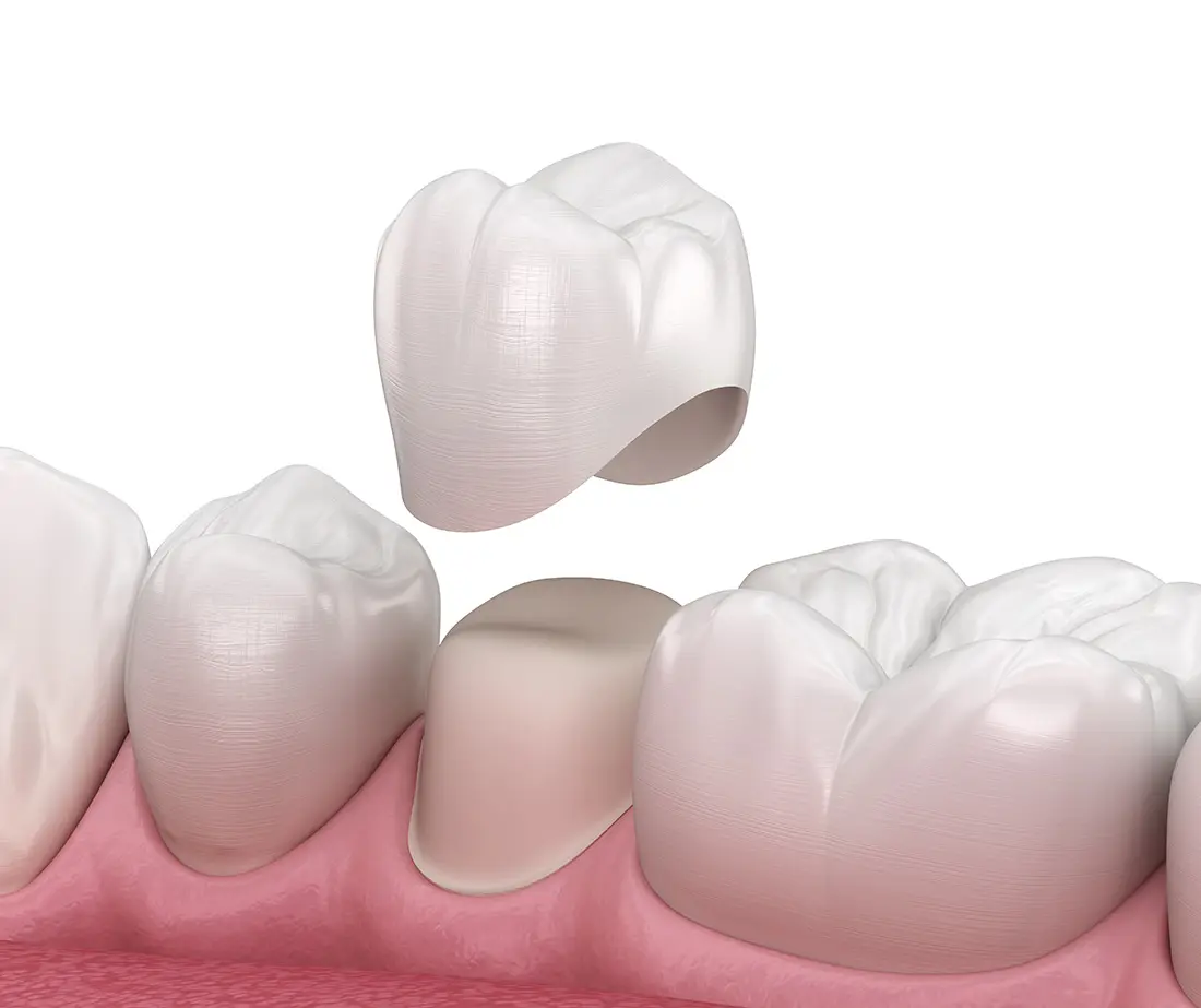 Dental Crowns at Spire Dental Care in Langley, BC
