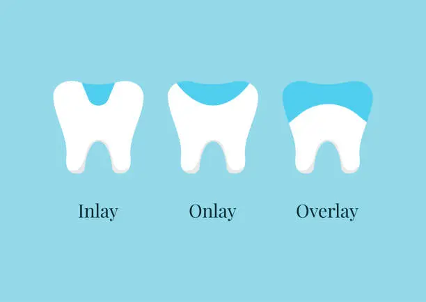 Dental Inlays & Onlays at Spire Dental Care in Langley, BC