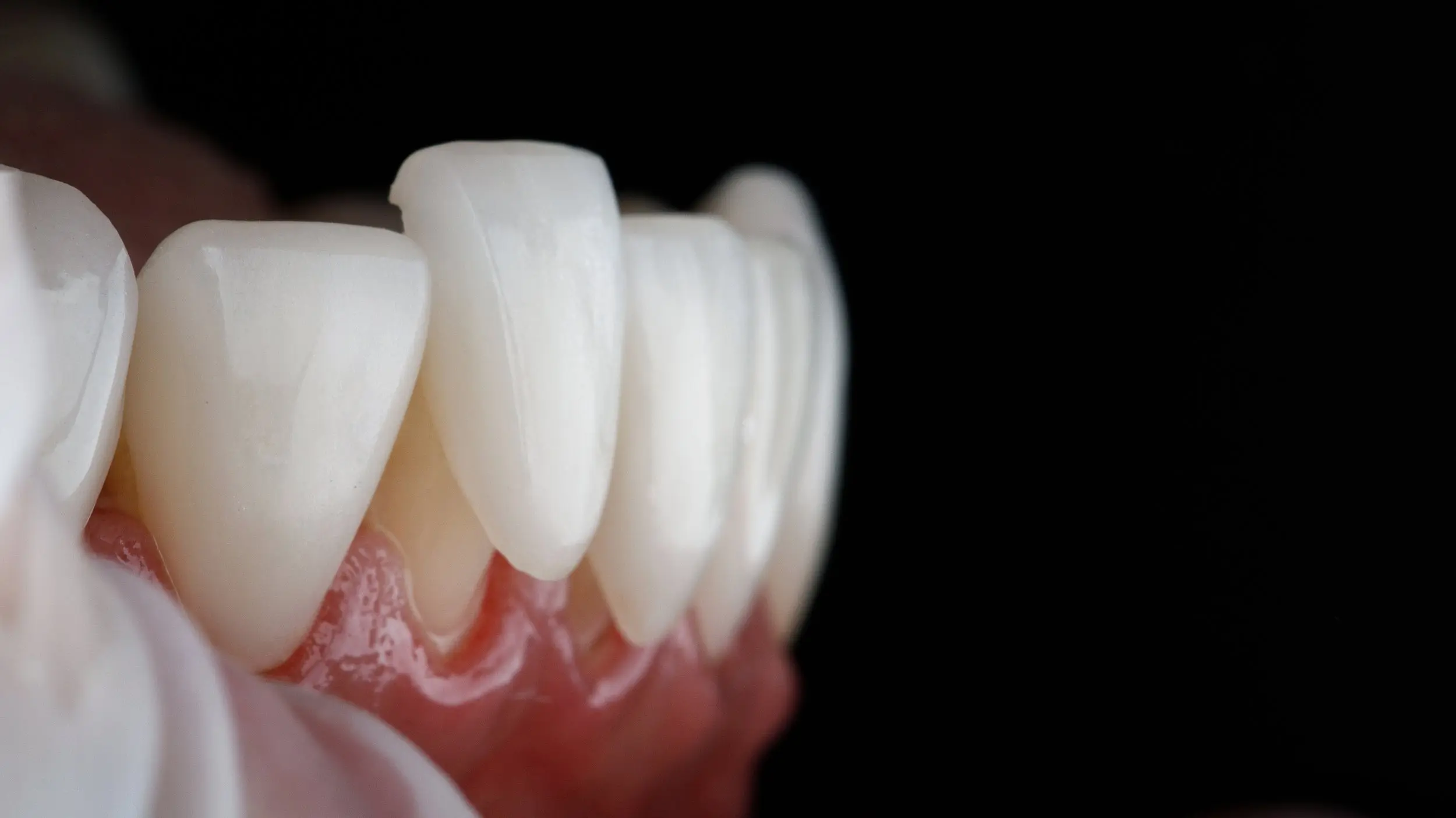 Dental Veneers at Spire Dental Care in Langley, BC
