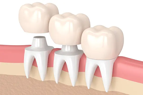 Lost Filling & Crown Emergency Care at Spire Dental Care in Langley, BC
