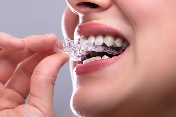 Night Guards & Mouth Guards at Spire Dental Care in Langley, BC