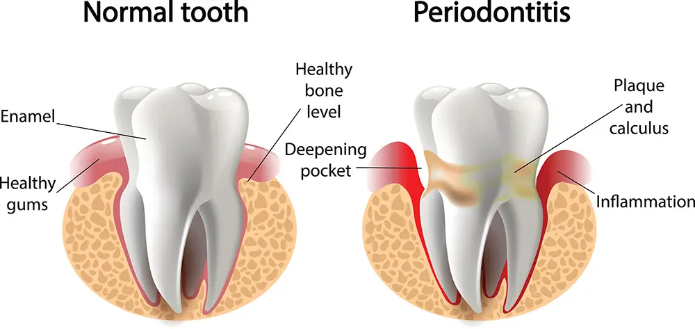 Periodontal Therapy at Spire Dental Care in Langley, BC