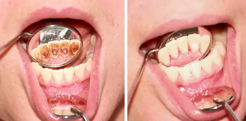 Plaque and Tartar Removal at Spire Dental Care in Langley, BC