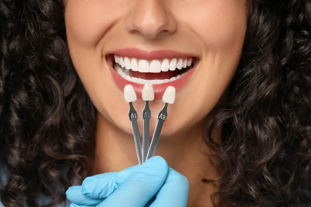 Porcelain Veneers at Spire Dental Care in Langley, BC