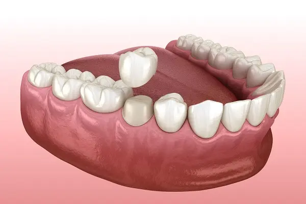 Post Root Canal Crown Placement at Spire Dental Care in Langley, BC