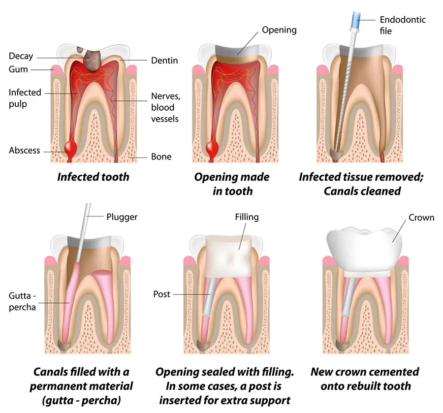 Root Canal Treatment at Spire Dental Care in Langley, BC