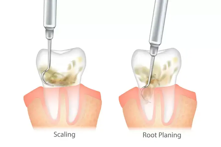 Deep Cleaning (Scaling and Root Planing) at Spire Dental Care in Langley, BC
