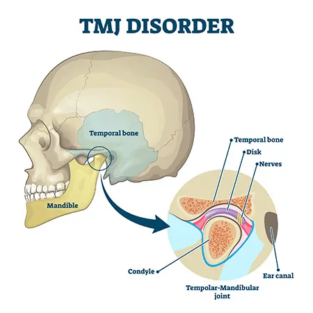 TMJ Treatment at Spire Dental Care in Langley, BC