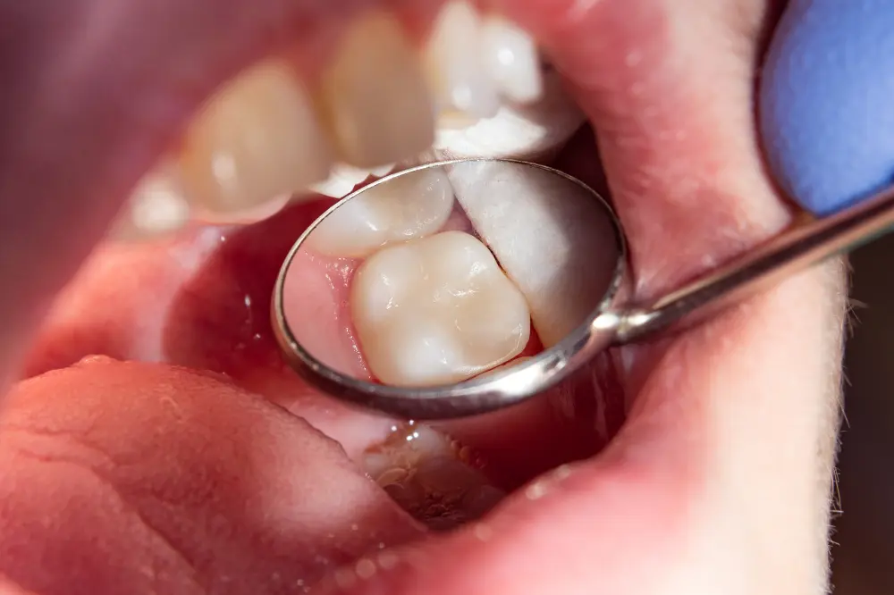 Tooth-Coloured Fillings at Spire Dental Care in Langley, BC