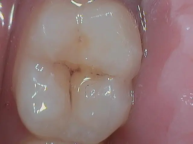 Black spots on teeth caused by tartar buildup near the gum line