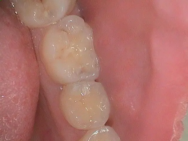 patient with black spots on tooth which are most likely cavities