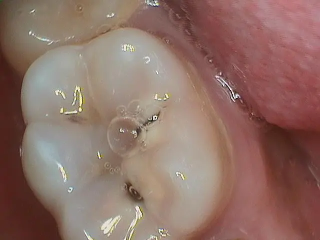 patient at spire dental with cavities