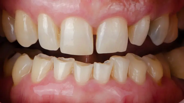 Teeth damaged by bruxism