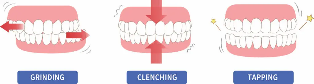 Teeth movements that cause bruxism such as grinding, clenching and tapping teeth