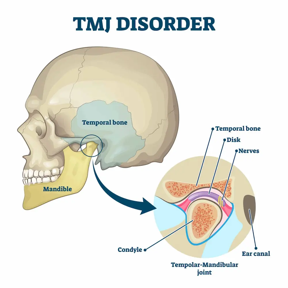 Anatomical diagram showing the temporomandibular joint structure