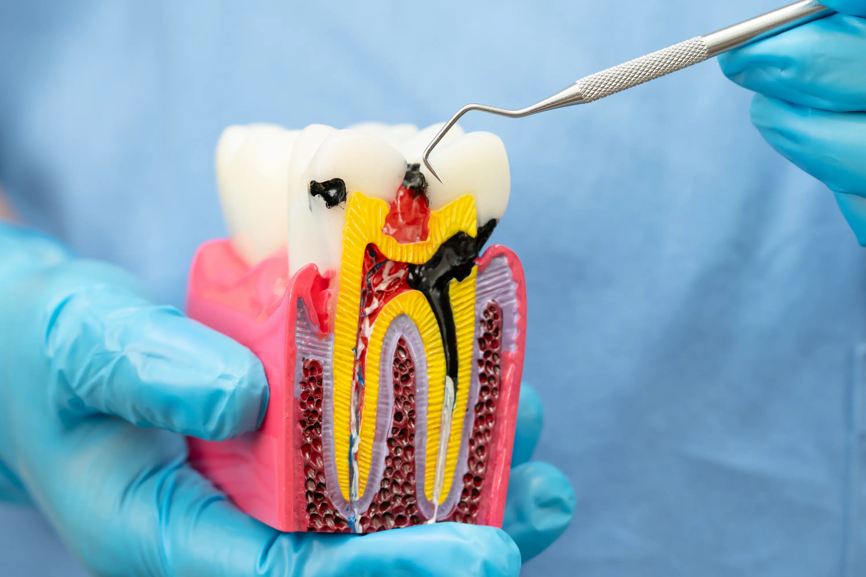 dentist model of tooth with nerve pain
