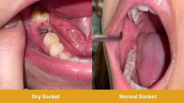 Comparison between normal healing socket and dry socket showing differences in appearance