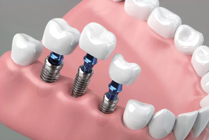 Dental implant as a replacement option after complete socket healing