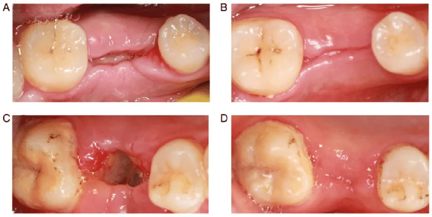 Healing progression of a wisdom tooth extraction site over time