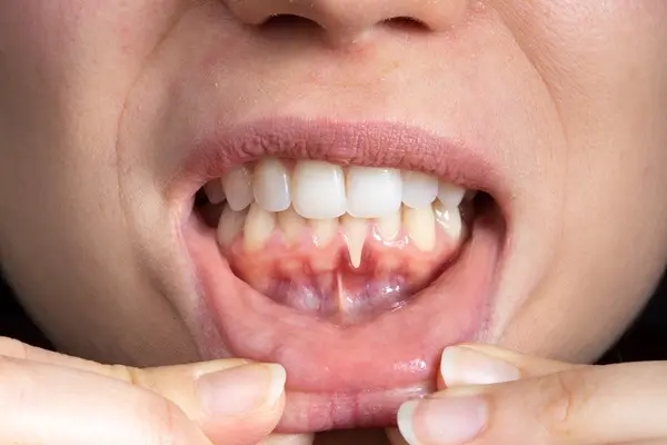 Receding gum on one tooth thats easy to spot