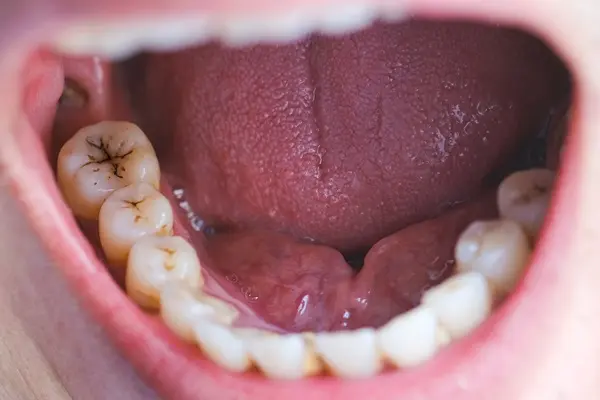 Foods to avoid with temporary fillings including hard candies, nuts, and sticky foods