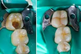 Temporary tooth filling