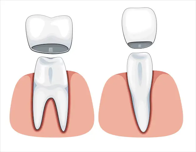 Tooth cap illustration on types of teeth