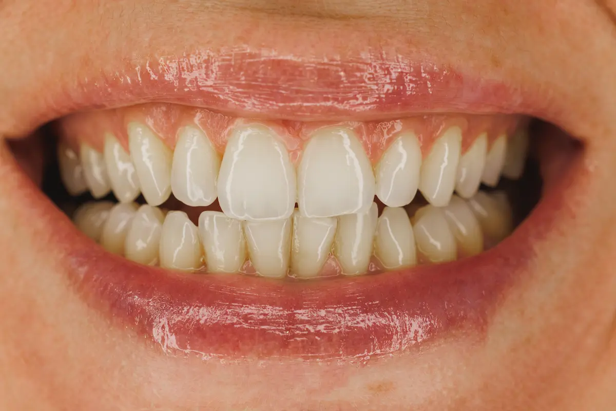 beautiful woman smile with veneers