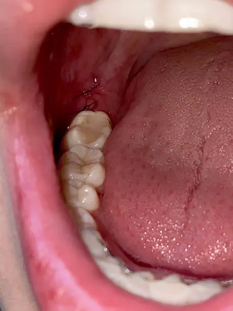 Wisdom tooth healing normally with stitches